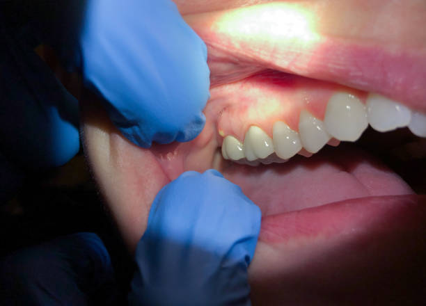 Best Emergency Gum Treatment in Skidaway Island, GA